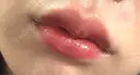 ヒアルロン酸注入（唇） 目白ホワイトクリニック AFTER サムネイル用