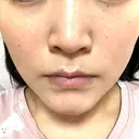 ルメッカ L‘amour clinic Tokyo【ラムールクリニック東京】 DAY 2 サムネイル用