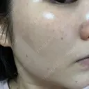 ルメッカ L‘amour clinic Tokyo【ラムールクリニック東京】 DAY 2 サムネイル用