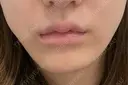 脂肪溶解注射（顔） 札幌美容外科ネビュラクリニック AFTER サムネイル用