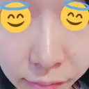 鼻孔縁挙上 / その他（鼻） シエルクリニック DAY 11 サムネイル用