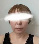 糸リフト / メーラーファット除去 / ジョールファット除去 / 脂肪吸引注射（顔） / ヒアルロン酸注入（鼻翼基部） ICON CLINIC DAY 105 サムネイル用