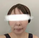 糸リフト / メーラーファット除去 / ジョールファット除去 / 脂肪吸引注射（顔） / ヒアルロン酸注入（鼻翼基部） ICON CLINIC DAY 108 サムネイル用
