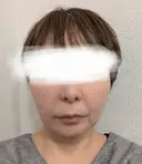 糸リフト / メーラーファット除去 / ジョールファット除去 / 脂肪吸引注射（顔） / ヒアルロン酸注入（鼻翼基部） ICON CLINIC AFTER サムネイル用