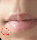シミ取りレーザー さっぽろ美容クリニック AFTER サムネイル用