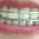 ホワイトニング LEAGRANT CLINIC 中目黒 DAY 2 サムネイル用