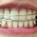 ホワイトニング LEAGRANT CLINIC 中目黒 DAY 3 サムネイル用