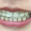 ホワイトニング LEAGRANT CLINIC 中目黒 DAY 4 サムネイル用