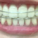 ホワイトニング LEAGRANT CLINIC 中目黒 DAY 5 サムネイル用