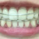 ホワイトニング LEAGRANT CLINIC 中目黒 DAY 6 サムネイル用