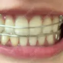 ホワイトニング LEAGRANT CLINIC 中目黒 DAY 7 サムネイル用