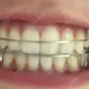 ホワイトニング LEAGRANT CLINIC 中目黒 DAY 8 サムネイル用