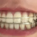 ホワイトニング LEAGRANT CLINIC 中目黒 DAY 9 サムネイル用
