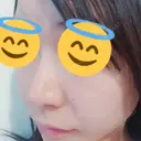 鼻孔縁挙上 / その他（鼻） シエルクリニック DAY 11 サムネイル用