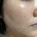 ルメッカ L‘amour clinic Tokyo【ラムールクリニック東京】 DAY 3 サムネイル用