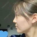 クマ治療 / リジュラン エートップ美容整形外科 DAY 75 サムネイル用
