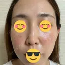 光治療（フォトフェイシャルなど） / ピーリング（ハリ・ツヤ） 東京美容クリニック 表参道本院 DAY 1 サムネイル用