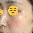 光治療（フォトフェイシャルなど） / ピーリング（ハリ・ツヤ） 東京美容クリニック 表参道本院 DAY 1 サムネイル用