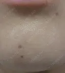 ほくろ・いぼ除去レーザー（肌） プライベートスキンクリニック 梅田本院 DAY 6 サムネイル用