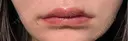 ヒアルロン酸注入（唇） 目白ホワイトクリニック AFTER サムネイル用