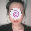 糸リフト MKクリニック 日本橋院 DAY 1 サムネイル用