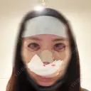 二重埋没 / 隆鼻術 / 鼻尖形成（切開） / 鼻中隔延長（切開） / 小鼻縮小（切開） / クマ治療 / 目尻切開 / 軟骨移植 / 鼻柱下降・鼻唇角形成（猫手術） WOM CLINIC GINZA （ワム クリニック ギンザ） AFTER サムネイル用