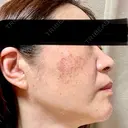 ルメッカ 東京シルククリニック 東京神田院 DAY 2 サムネイル用