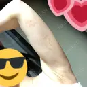 脂肪吸引（二の腕） / 脂肪溶解注射（二の腕） THE SKINNY CLINIC（ザ・スキニークリニック） DAY 11 サムネイル用