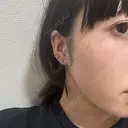 糸リフト MKクリニック 日本橋院 DAY 2 サムネイル用