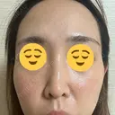 光治療（フォトフェイシャルなど） / ピーリング（ハリ・ツヤ） 東京美容クリニック 表参道本院 DAY 3 サムネイル用