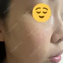 光治療（フォトフェイシャルなど） / ピーリング（ハリ・ツヤ） 東京美容クリニック 表参道本院 DAY 3 サムネイル用