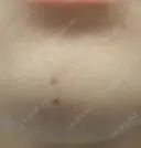 ほくろ・いぼ除去レーザー（肌） プライベートスキンクリニック 梅田本院 DAY 8 サムネイル用