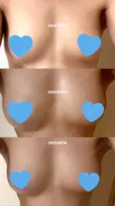 豊胸（脂肪注入） Lipo Clinic omotesando DAY 63 サムネイル用