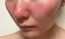 エレクトロポレーション / 毛穴洗浄（ハイドラフェイシャルなど） ウィルビークリニック 新宿院 DAY 0 サムネイル用