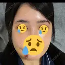 骨切り（あご） / 骨削り（エラ） / 骨削り（頬） リッツ美容外科 東京院 DAY 10 サムネイル用