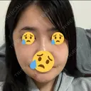 骨切り（あご） / 骨削り（エラ） / 骨削り（頬） リッツ美容外科 東京院 DAY 15 サムネイル用