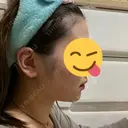 糸リフト / 脂肪吸引（顔） / ジョールファット除去 GRACIA clinic 【グラシアクリニック】 AFTER サムネイル用