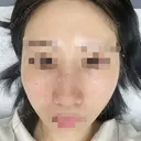 鼻尖形成（切開） / 鼻中隔延長（切開） / 軟骨移植 / 骨切幅寄せ / ワシ鼻修正・ハンプ切除 / 斜鼻修正 / 鼻修正 リッツ美容外科 東京院 DAY 16 サムネイル用