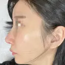 鼻尖形成（切開） / 鼻中隔延長（切開） / 軟骨移植 / 骨切幅寄せ / ワシ鼻修正・ハンプ切除 / 斜鼻修正 / 鼻修正 リッツ美容外科 東京院 DAY 21 サムネイル用