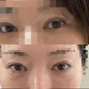 ヒアルロン酸注入（涙袋） / ヒアルロン酸注入（こめかみ） DMTC CLINIC 日本橋院 DAY 0 サムネイル用