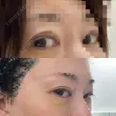 ヒアルロン酸注入（涙袋） / ヒアルロン酸注入（こめかみ） DMTC CLINIC 日本橋院 DAY 0 サムネイル用
