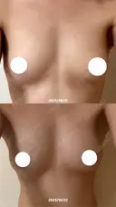 豊胸（脂肪注入） Lipo Clinic omotesando AFTER サムネイル用