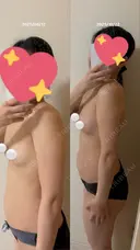 豊胸（脂肪注入） Lipo Clinic omotesando DAY 71 サムネイル用