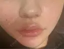 ヒアルロン酸注入（唇） 目白ホワイトクリニック DAY 1 サムネイル用