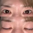 二重切開 / 目頭切開 / 上まぶたたるみ取り 湘南美容クリニック 大阪京橋院 AFTER サムネイル用