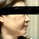 ルメッカ 東京シルククリニック 東京神田院 DAY 5 サムネイル用