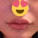 ヒアルロン酸注入（唇） 目白ホワイトクリニック AFTER サムネイル用