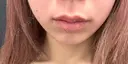 ヒアルロン酸注入（唇） / ボトックス（口角） ルラ美容クリニック 仙台院 / ルラスキンクリニック 仙台院 DAY 0 サムネイル用