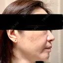 ルメッカ 東京シルククリニック 東京神田院 DAY 7 サムネイル用