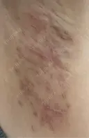 ワキ汗治療（切開） 石倉クリニック 水戸院 DAY 102 サムネイル用